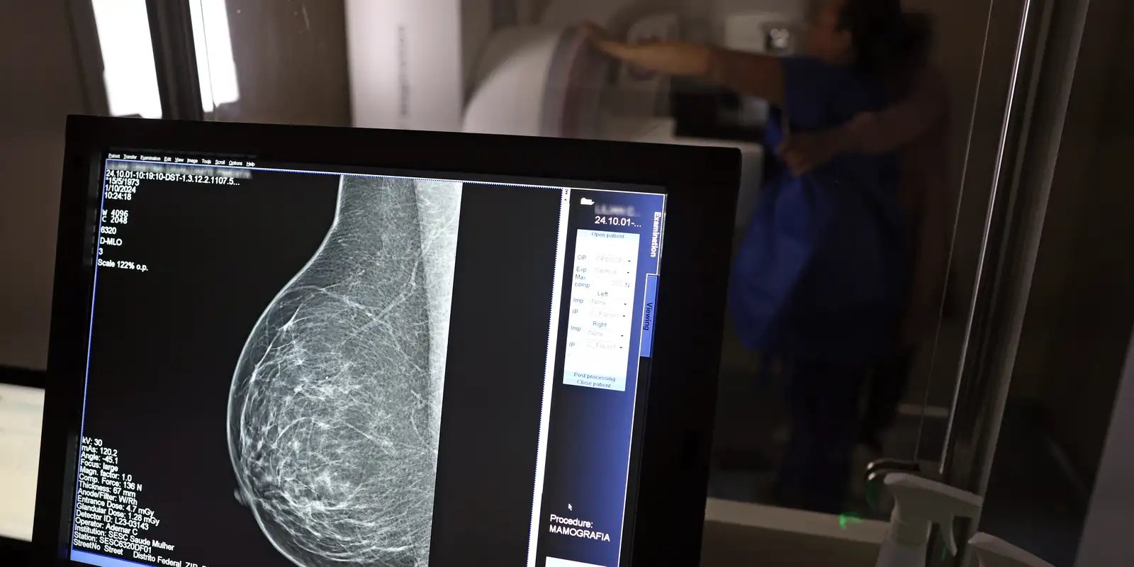 cancer-de-mama:-uma em-cada-tres pacientes tem-menos-de-50-anos